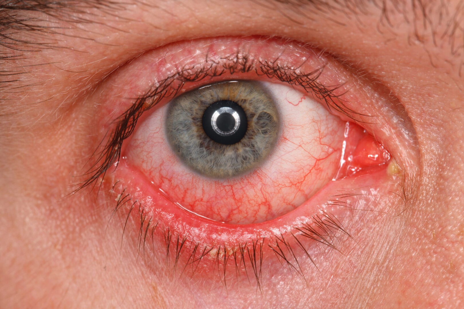 IMSS: Conjuntivitis